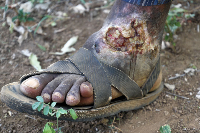 Spitting cobra bite wound