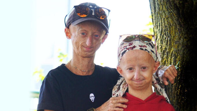 People with the genetic disease progeria