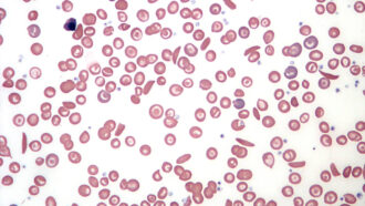 a microscopic image showing the sickle curved shape of blood cells