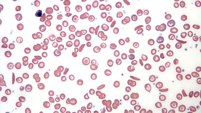a microscopic image showing the sickle curved shape of blood cells