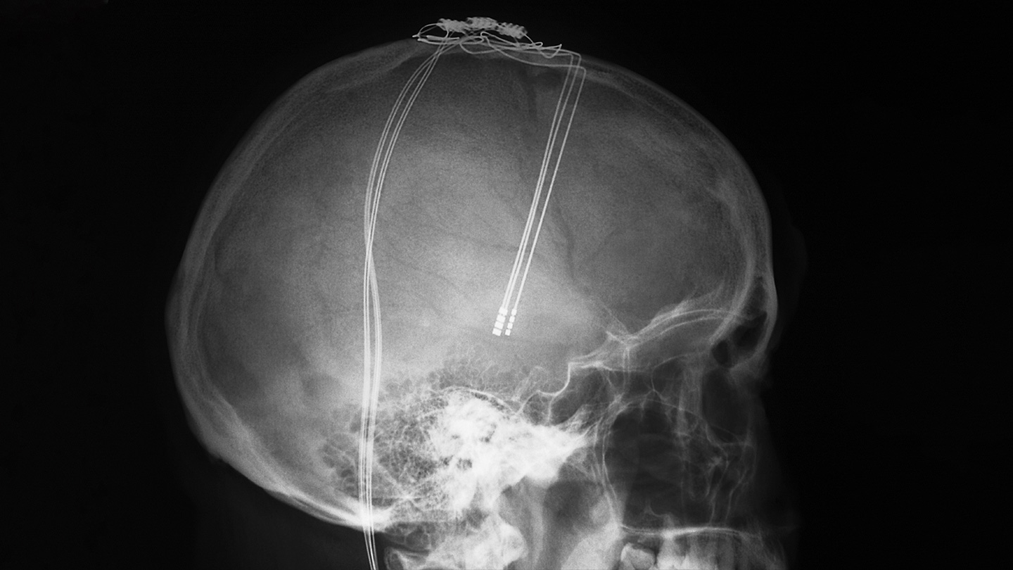 X-ray of electrodes in the brain of a patient with Parkinson's disease