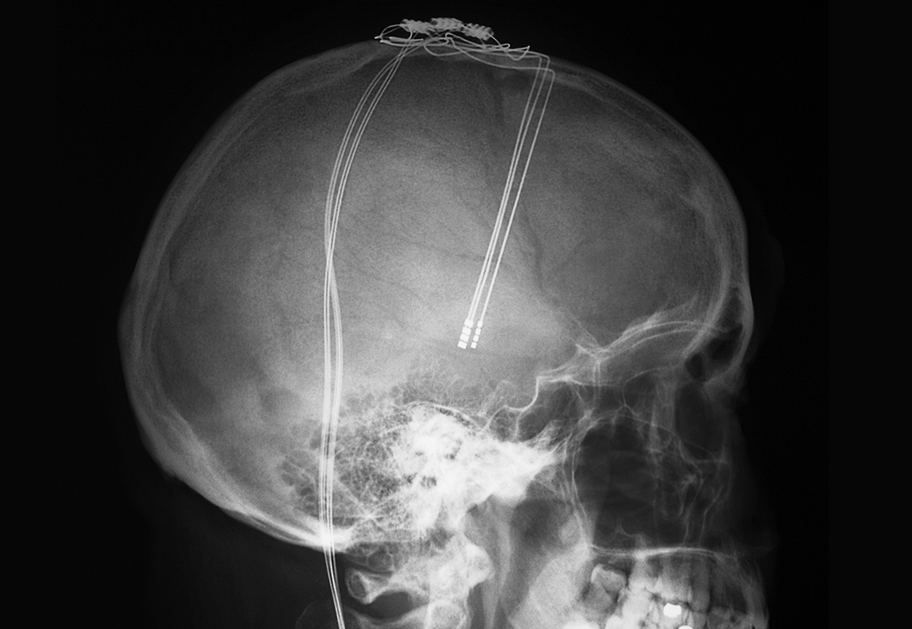 x-ray of electrodes in a person's skull