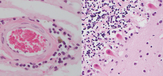 left: inflamed immune cells around blood vessel. right: cells affected by COVID-19