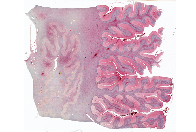 clotting protein in postmortem brain from person with COVID-19