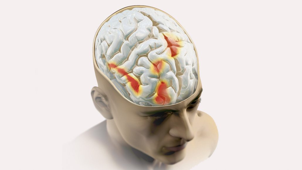 illustration of a brain with parts stimulated highlighted in red and yellow