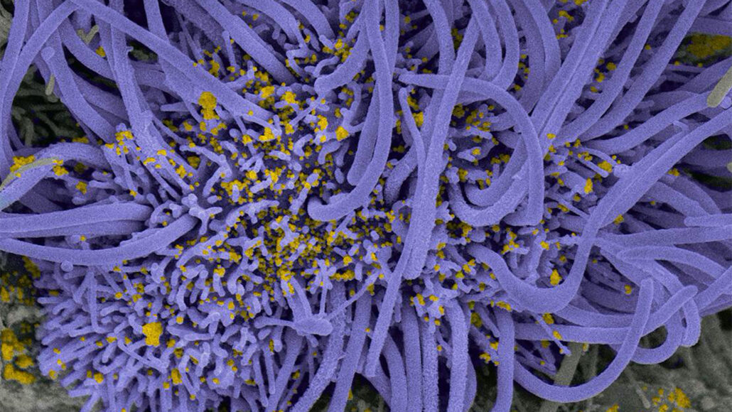hairlike cilia (shown in purple) shown at full length and cut short by coronavirus (shown in yellow)