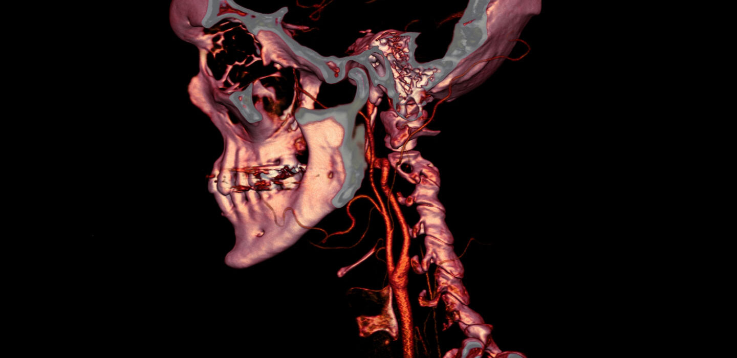 CT scan image of a head and neck where some tissues and veins appear red