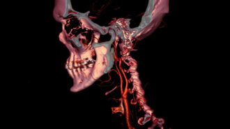 CT scan image of a head and neck where some tissues and veins appear red