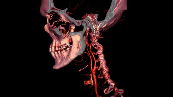 CT scan image of a head and neck where some tissues and veins appear red