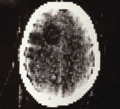 first CT image of a patient showing the brain area