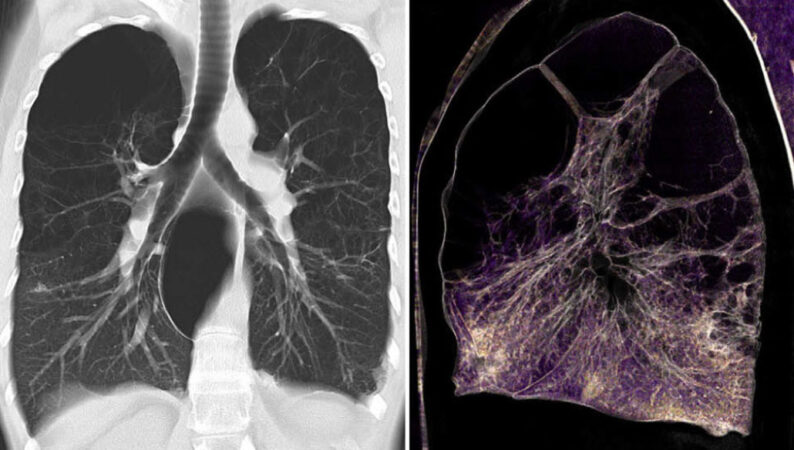 a black and white 2-D lung scan next to a purple-colored 3-D rendering