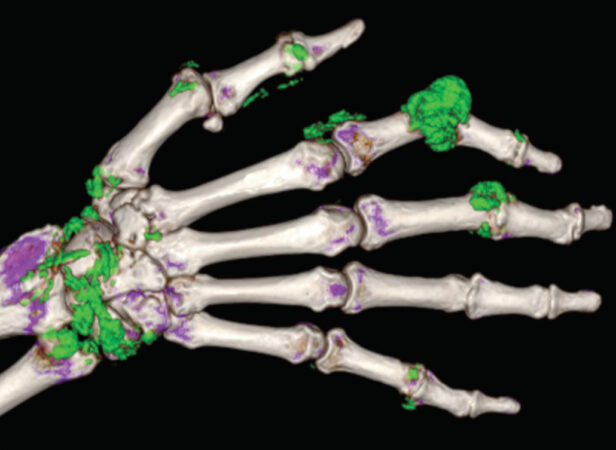 CT scan of a hand showing urate crystals around the wrist and finger joints in green
