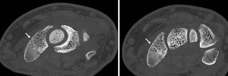 images of a broken wrist in a regular CT scan and a photo-counting CT scan