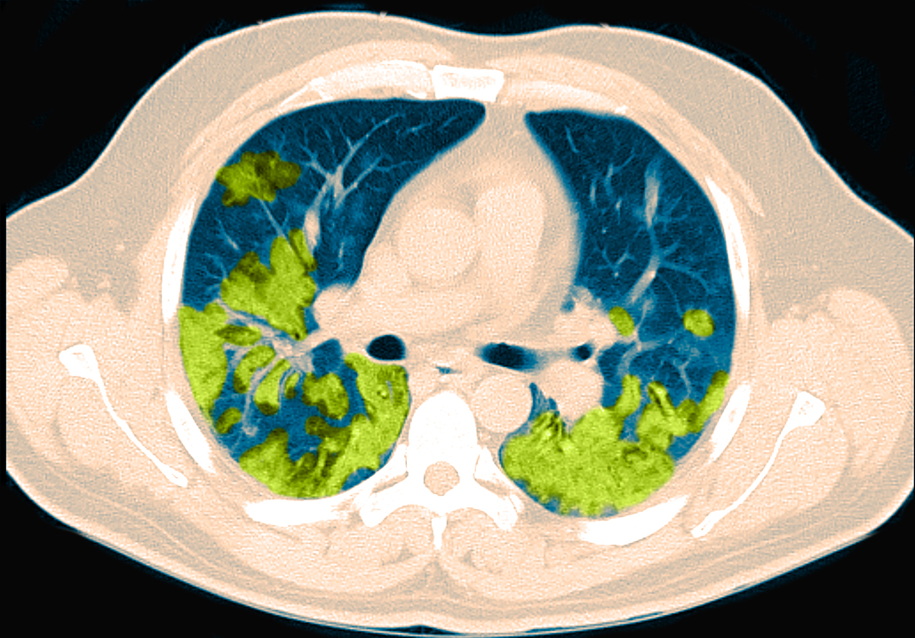 colorized CT scan showing areas of the lung damaged by covid in green and non-damaged areas in blue