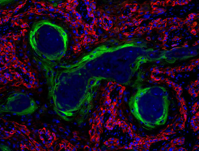 microscope image of a squamous cell carcinoma in a mouse