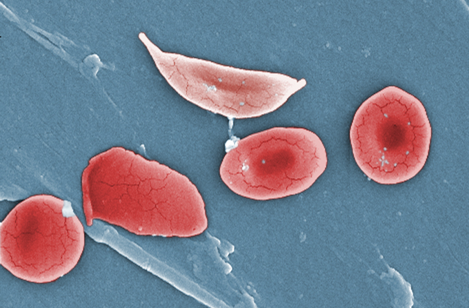 microscope image of a sickle cell with other red blood cells