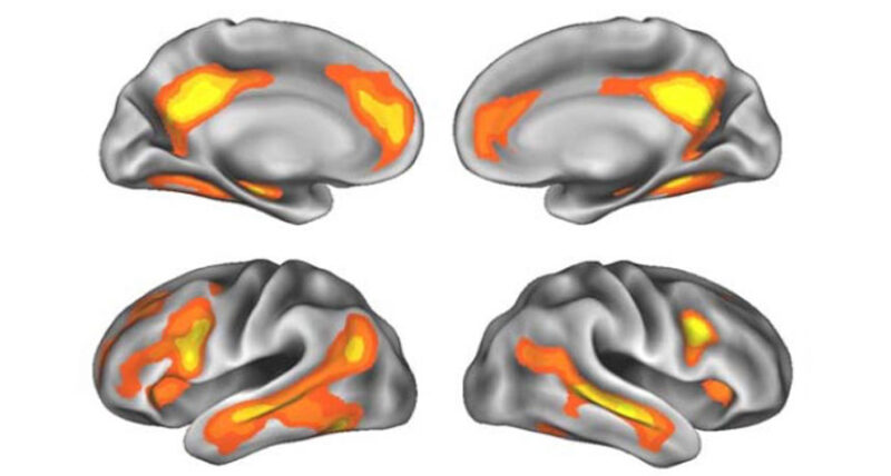 four views of the brain with regions that get smaller during pregnancy highlighted in yellow and orange