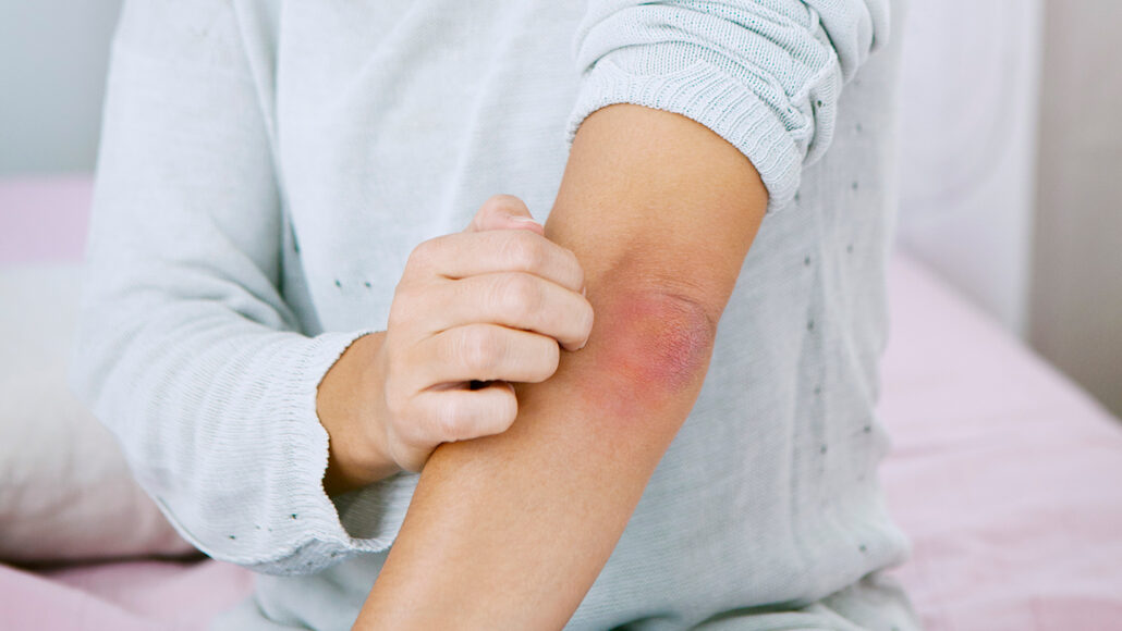 a photo of a hand scratching red scaly skin on a person's elbow. Only the person's torso and arms are in frame.