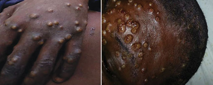 pustules from monkeypox on a person's hand and head