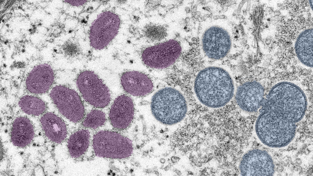 electron micrograph of mature monkeypox viruses in pink and immature viruses in blue