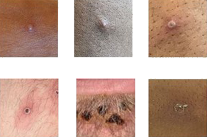 six images of different types of skin lesions caused by monkeypox
