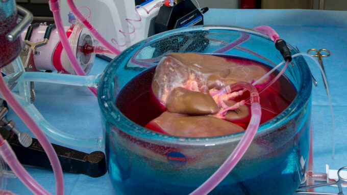 In 2019, scientists found a way to store human livers for more than a day at subzero temperatures without the organs freezing (shown). The technique could eventually help ease the shortage of donor organs, saving thousands of lives.