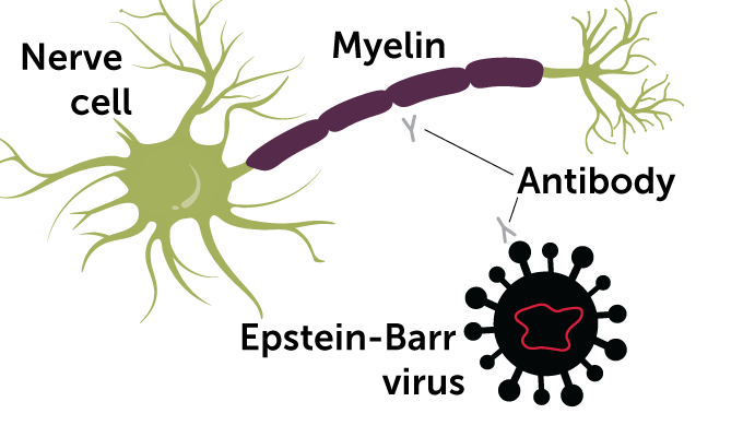 a diagram showing how the immune system attempts to attack the Epstein-barr virus cause attacks on the myelin sheath on nerve cells