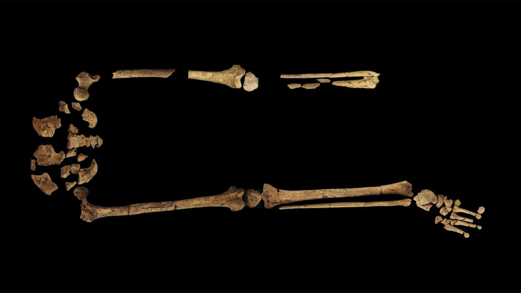 image of a young adult’s skeleton with the lower left leg absent