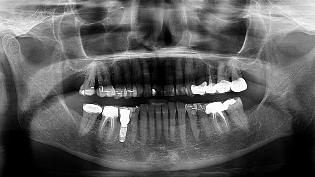 An X-ray image shows a person's jaw, including a tooth implant in the lower left jaw