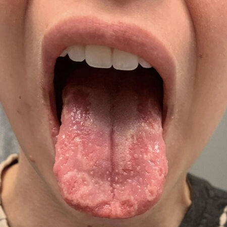 A person sticking out their tongue, revealing many white lesions and swollen patches