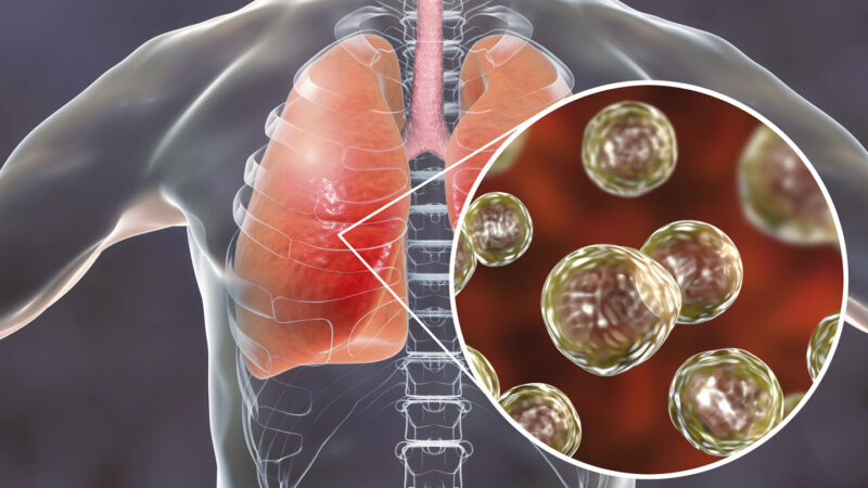 medical illustration of a human body with lungs and a zoom in view that shows Blastomyces fungal spores in the lungs