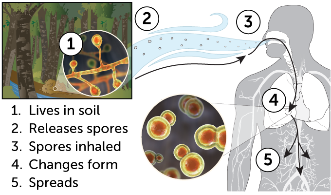 a chart showing the path to infection from fungi living in soil that release spores, which are then inhaled, change form within the body and spread