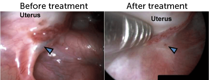 Due immagini affiancate che mostrano la lesione dell'endometriosi di una scimmia.  A sinistra c'è una lesione chiara ea destra mostra la lesione ridotta dopo 12 mesi di trattamento.