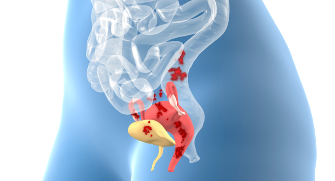 Un diagramma dell'organo riproduttivo interno di una donna che mostra le lesioni dell'endometriosi sull'utero, sulle ovaie e sulla vescica.