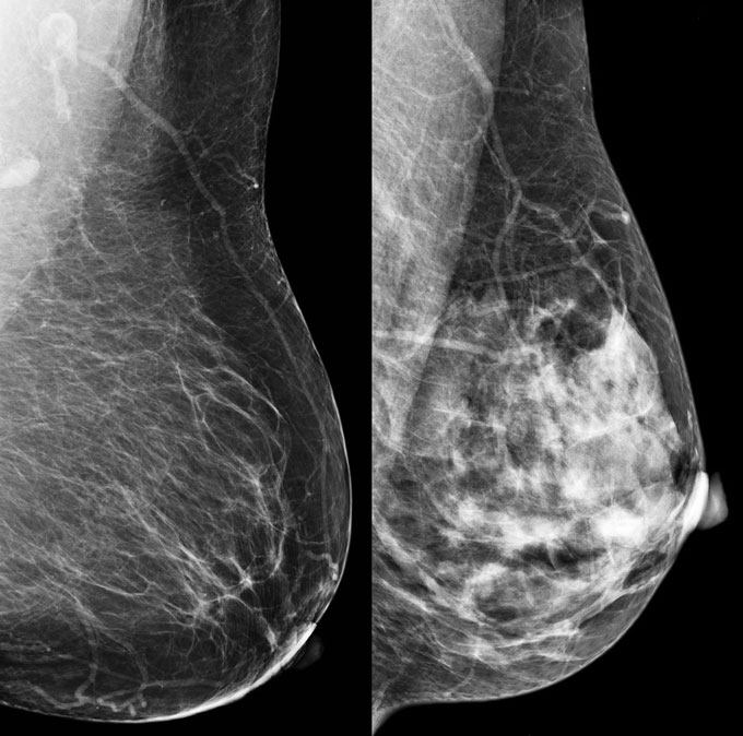 Two x-ray images of breasts. The image on the left shows the breast's fatty tissue as more transparent while the image on the right shows more dense breast tissue which appears white.