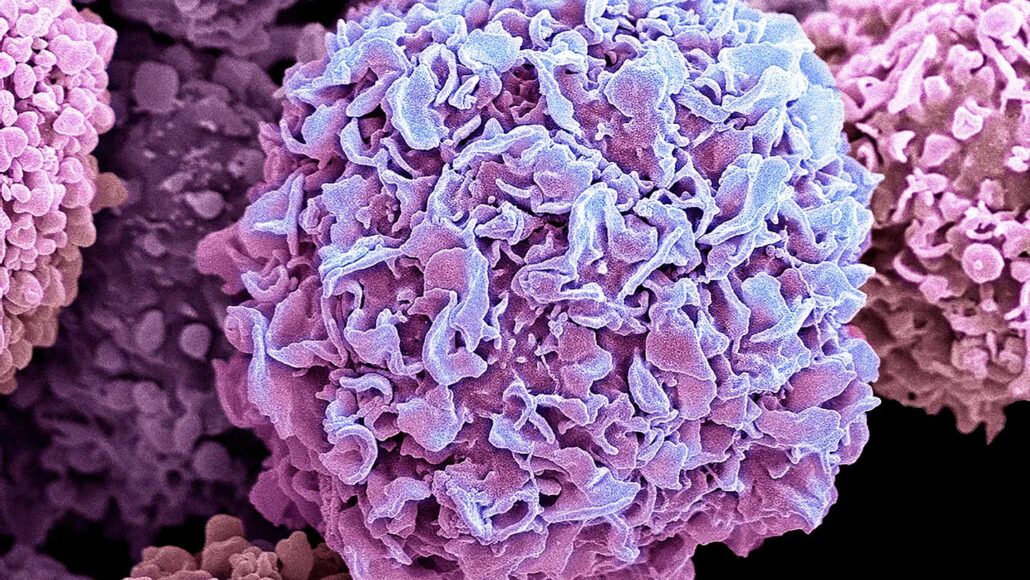 An SEM image of breast cancer cells.