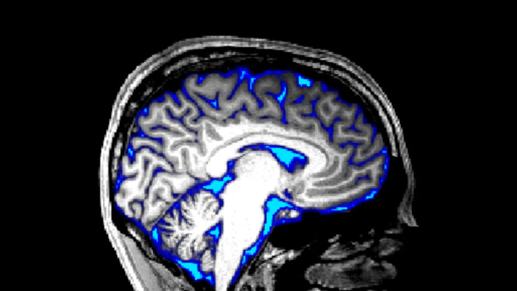 A MRI image of a brain shows regions of cerebrospinal fluid in blue.