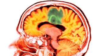 A CT scan image showing a human brain in yellow with a big patch of green in the middle of the brain.
