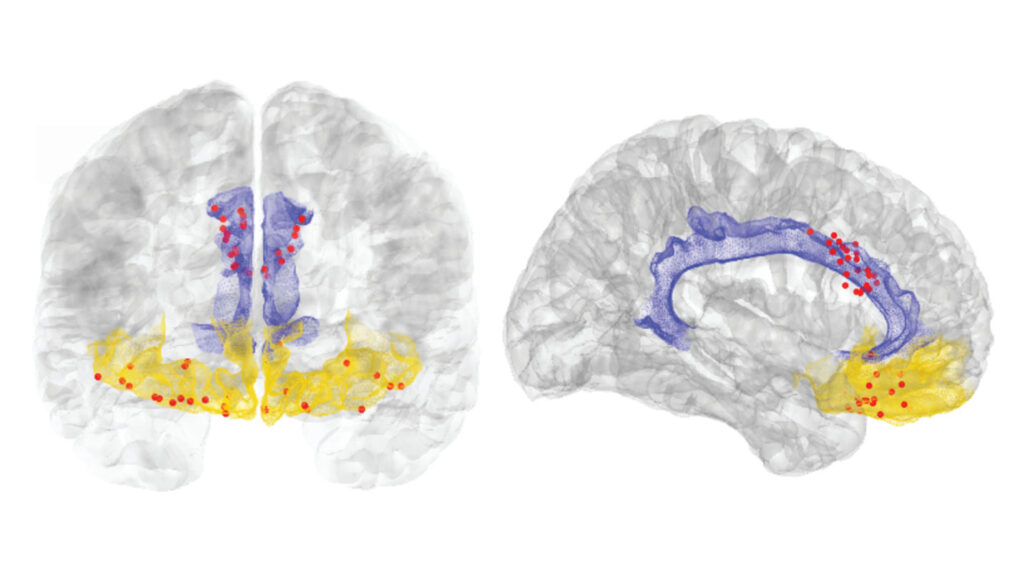Two images of a brain. The image on the left shows a forward-facing brain scan with a purple section in the middle and yellow sections on the bottom, both with red dots scattered throughout the colored sections. The image on the right is a profile view of the same brain with the same colored section.