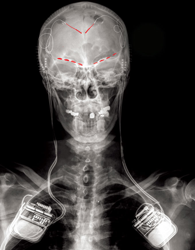 An x-ray image of a person's head, neck and shoulders. Two boxes with wires are attached to the head and red lines appear on the skull.