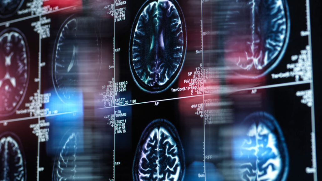 A photo of several brain scans.