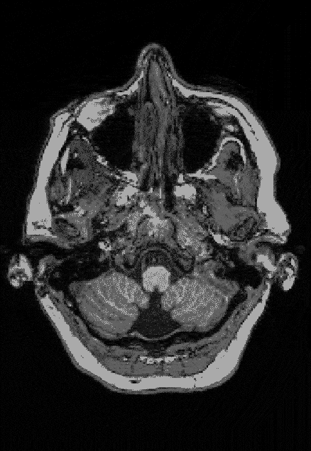 A gif showing the MRI scan of Elyse G. and the large chunk of her brain missing on the left hand side.