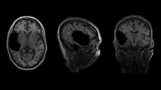 Three views of a brain scan from different angles showing a big black spot in a woman's brain.