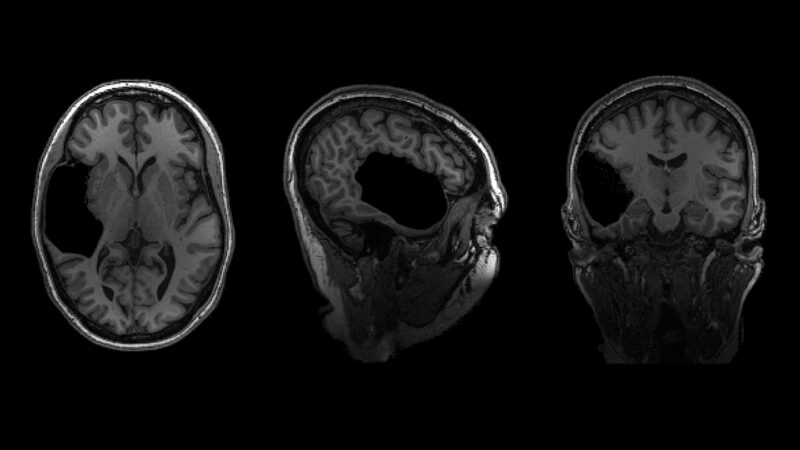 Three views of a brain scan from different angles showing a big black spot in a woman's brain.