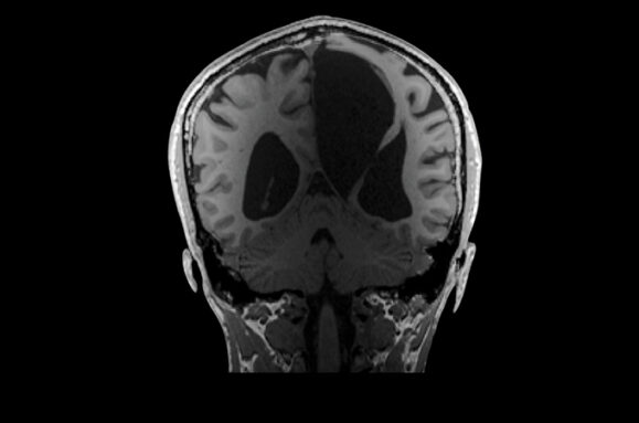 An MRI scan of E.S.'s brain with one large and two smaller dark patches in the middle of the brain.