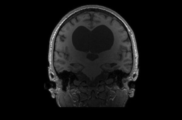 An image of an MRI scan with a large black area in the middle of K.V.'s brain in the shape of a heart.