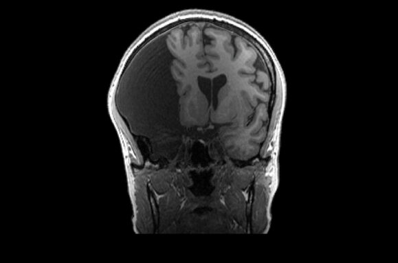 An image of an MRI scan of G.C's brain showing a very large dark section on the left side and the brain pushed to the right.