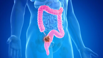 An illustration of a blue person's colon highlighted in pink with a chunk of brown resting in the colon.