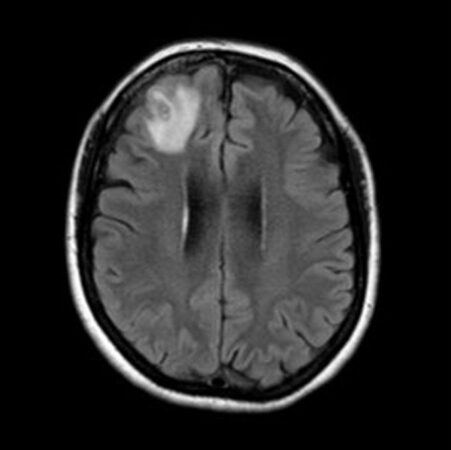 Uma imagem de ressonância magnética mostrando uma região cinza claro do cérebro de uma pessoa.