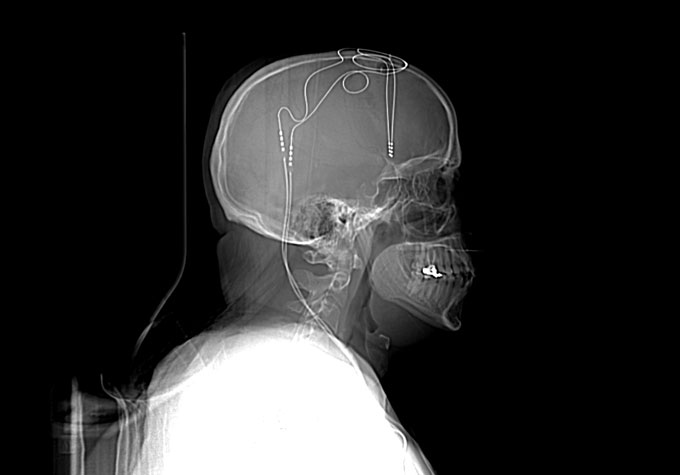 CT scan of electrodes in a person's brain